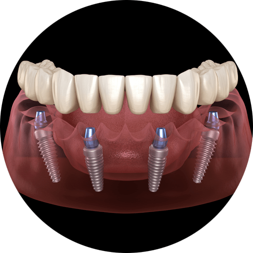 full mouth dental implants