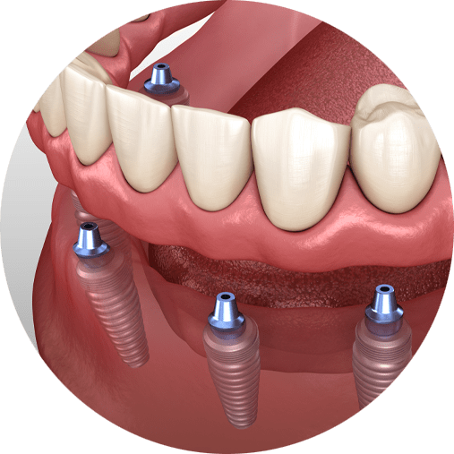 implant supported dentures
